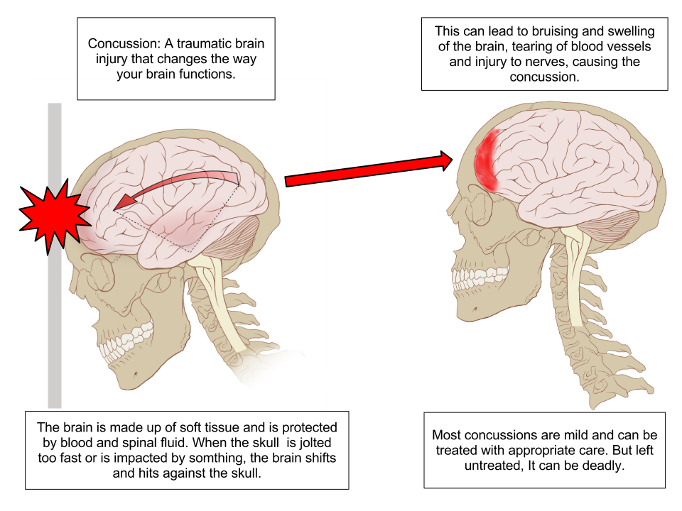 Concussion_Anatomy